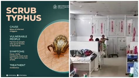 7 More Scrub Typhus Cases Take Sundargarh S Tally To 200 Total 839 In