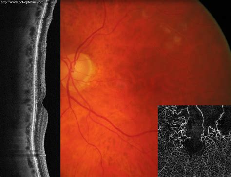 OCT angiography & vascular diseases