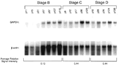 Northern Blot Analysis Of Gapdh Gene Expression In Pathologic Stage B