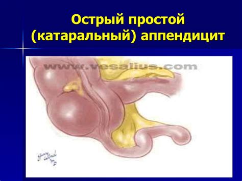 Острый аппендицит - презентация онлайн