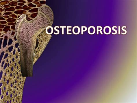 Ppt Osteoporosis Powerpoint Presentation Free Download Id8843742