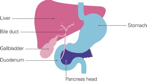 Types Of Surgery For Pancreatic Cancer Pancreatic Cancer Uk