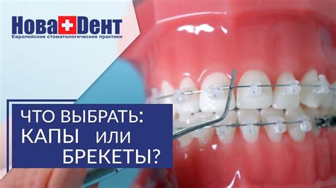 Брекеты или капы. Какой вариант лечения выбрать — брекеты или капы ...
