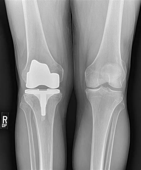 KNEE REPLACEMENT 6 Buyxraysonline