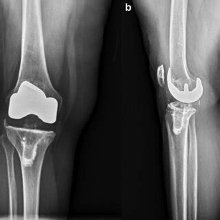 A Anteroposterior And B Lateral Radiographs Of The Right Knee Of