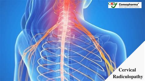 Cervical Radiculopathy Causes Symptoms And Treatment Consopharma