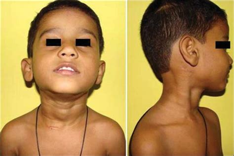 At 12 Months Postoperative Photographs Showing Straight Neck With A