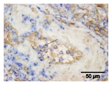 Immunohistochemical Detection Of Tgm2 And Cd163 Immunohistochemical Download Scientific