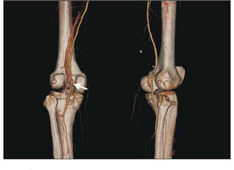 Figure From Popliteal Artery Entrapment Syndrome Presented With