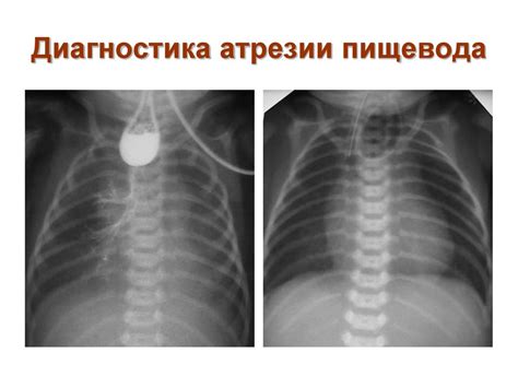 Атрезия пищевода и трахеопищеводный свищ - презентация онлайн