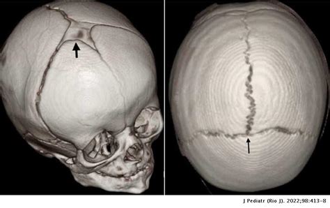 Anterior fontanelle closure and diagnosis of non-syndromic ...