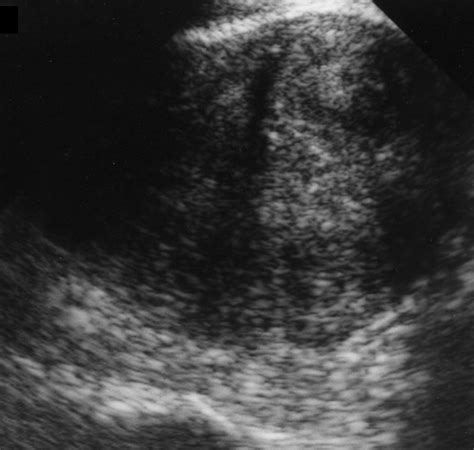 Adenomyosis Ultrasound