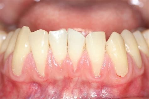 Gum Recession Treatment Surgery Gum Regeneration Treatment