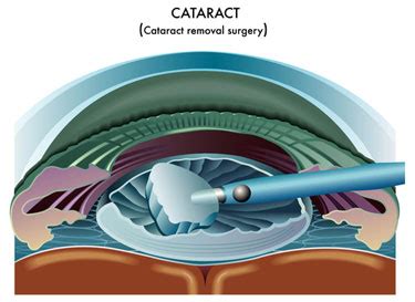 Cataract Surgery Edison | Eye Lens Replacement Kendall Park
