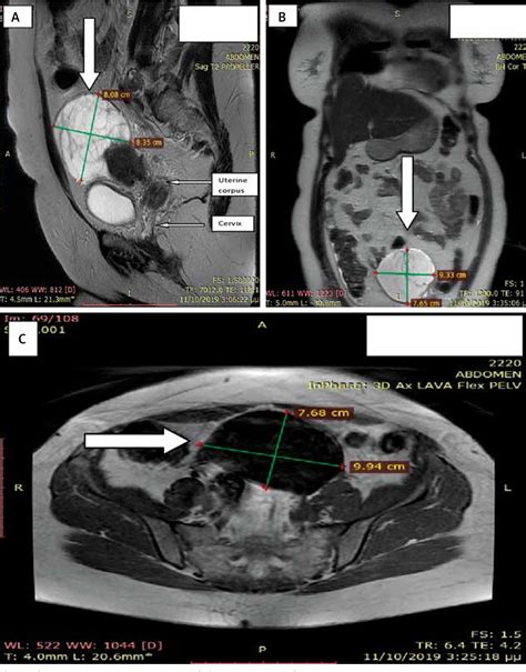 Figure 1 From A Rare Case Of Gastric Type Mucinous Endocervical Adenocarcinoma In A 59 Year Old