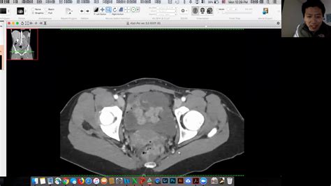 Abdominal Pain R O Appy Dx Ovarian Torsion Victor Sai Youtube