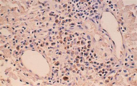 Nodular Amyloidosis Review And Long Term Follow Up Of 16 Cases