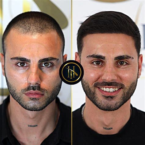 Hair Transplant Before And After Artofit