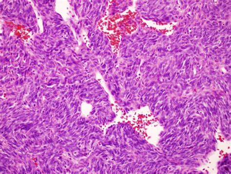 Cutaneous Vascular Anomalies: Hemangiopericytoma | Dr. Perri