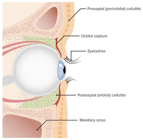 Orbital And Preseptal Cellulitis Concise Medical Knowledge