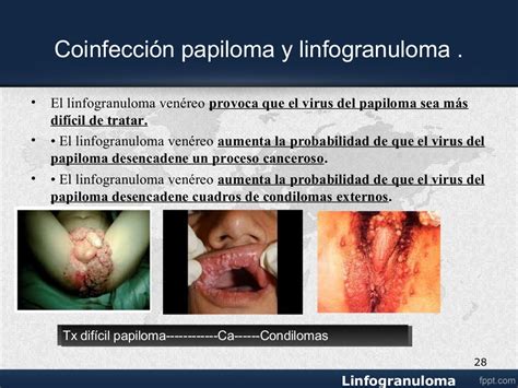 Linfogranuloma Venereo