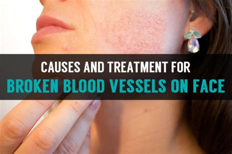 Causes And Treatment For Broken Blood Vessels on Face