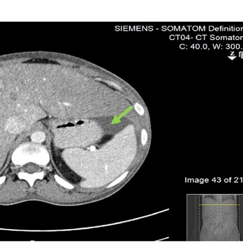 a CT of the abdomen (arrow) showed periportal edema with ascites. b CT... | Download Scientific ...