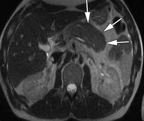 Chronic Pancreatitis Or Pancreatic Tumor A Problem Solving Approach