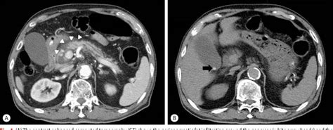 Figure 1 From Intramural Duodenal Hematoma After Transpancreatic