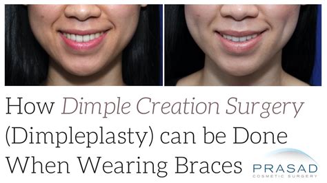 How Dimple Creation Surgery (Dimpleplasty) can be Done on People with ...