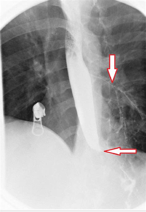 Barium Swallow Showed Significant Hold Up Of Contrast At The Distal End