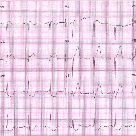 An Electrocardiogram Obtained In The Emergency Room Showed Normal Sinus