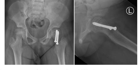 Figure From Capital Femoral Epiphysis With Acute Unstable Valgus Type