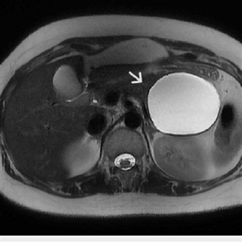 Magnetic Resonance Imaging Revealed A Well Defined Unilocular Cystic Download Scientific