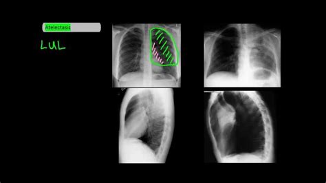 Lobar Atelectasis On Frontal And Lateral Chest X Rays [undergroundmed