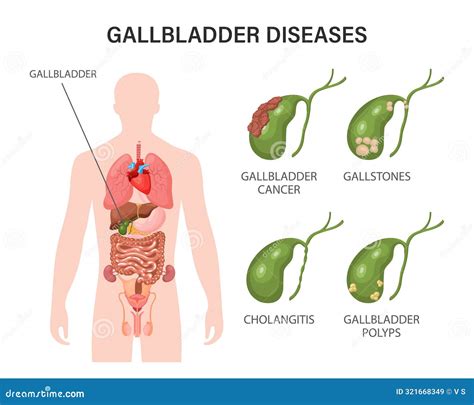 Gallbladder Diseases Infographics Gallstone Disease Cancer Acute