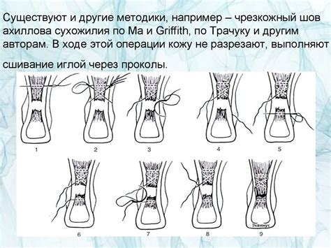 Разрыв ахиллова сухожилия - online presentation