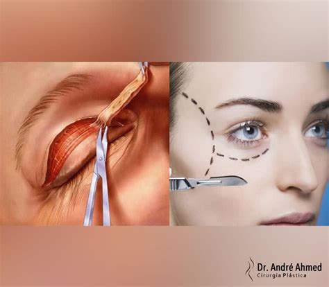 Blefaroplastia saiba mais sobre a cirurgia plástica das pálpebras