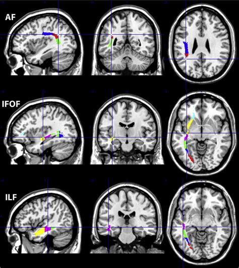 Pdf Diffusion Tensor Imaging Of Major White Matter Tracts And Their