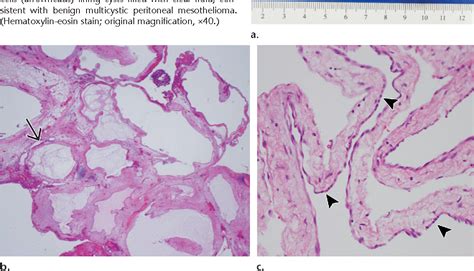 Benign Multicystic Peritoneal Mesothelioma 1 Semantic Scholar