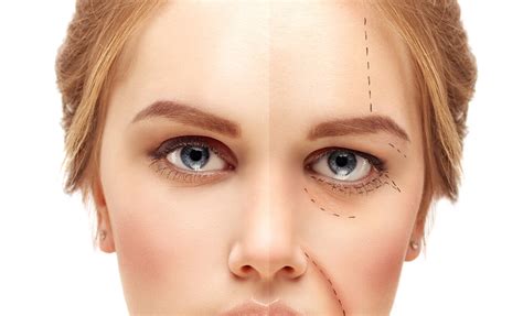 Plástica ocular e Botox o que você precisa saber HOlhos