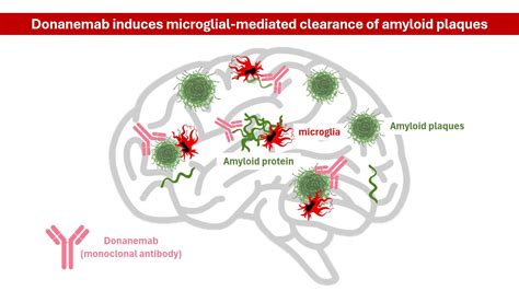 Donanemab For Alzheimers Mechanism Of Action Key Clinical Study