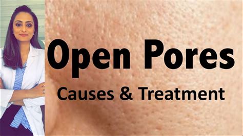 Open Pores Causes And Treatment Dermatologists Opinion Dr Aanchal Panth Youtube