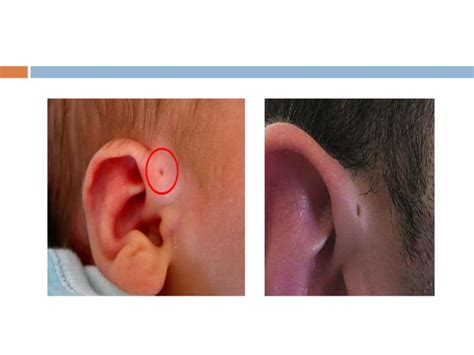 Congenital Ear Deformities