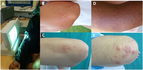 Frontiers Summer And Spring Elbow Rashes Is A Variant Of Polymorphous