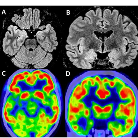 FIGURE Structural Brain Imaging In Case E Interictal Cerebral MRI