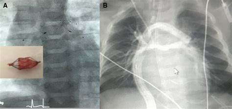 A B Anteriorposterior X Ray Of A Cctga Patient Treated With Pfrs And