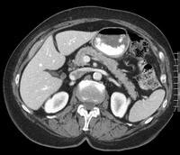 Abdomen Pelvis Ct Scan St Elizabeth S Medical Center Steward