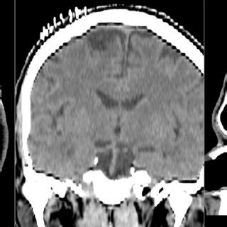 Postoperative Ct Scan Of The Patient After Operative Removal Of The