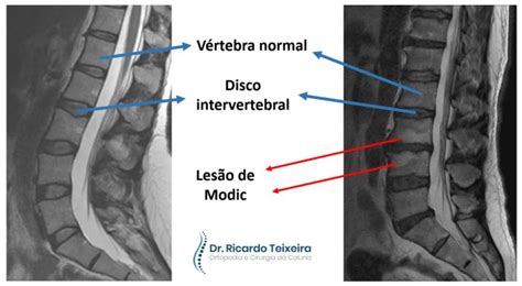 Lesões De Modic Dr Ricardo Teixeira Especialista Em Coluna